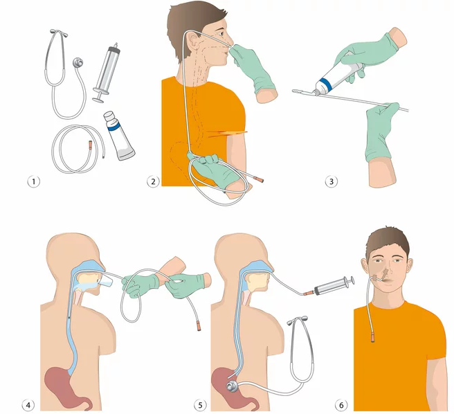 Quy Trình Đặt Sonde Dạ Dày Tại Nhà